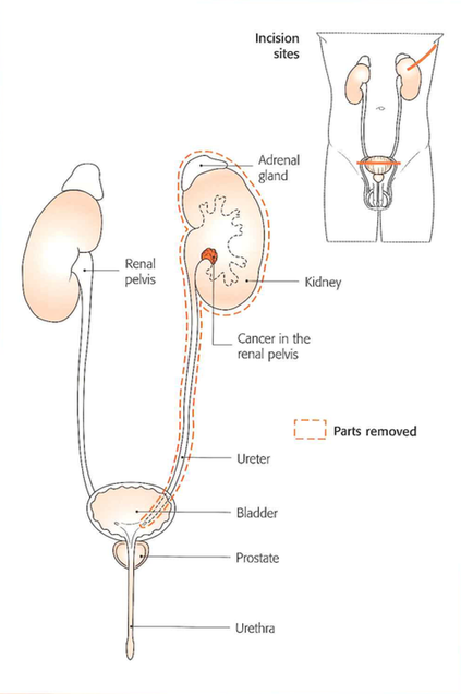 Nieres un urīnvada izņemšana Nieres un urīnvada izņemšana